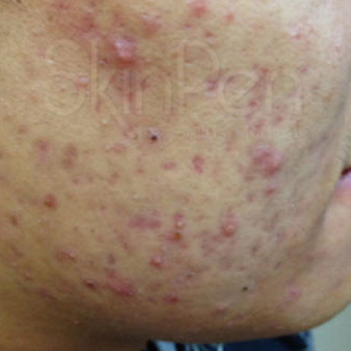 Acne-Scars-Before