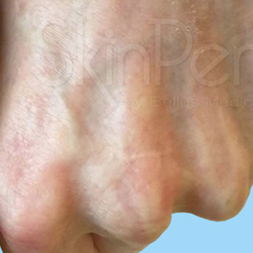 SkinPen-Hand-After